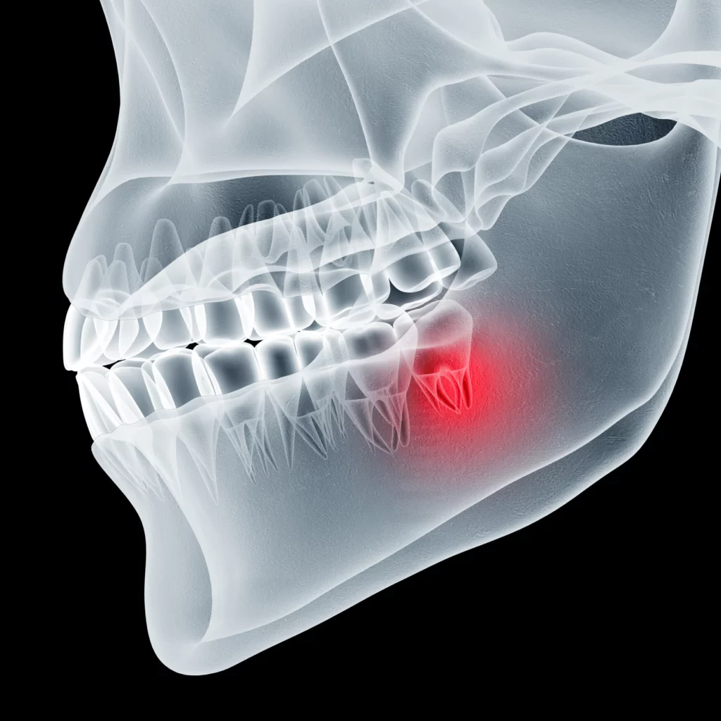 wisdom teeth removal in Lenexa, KS