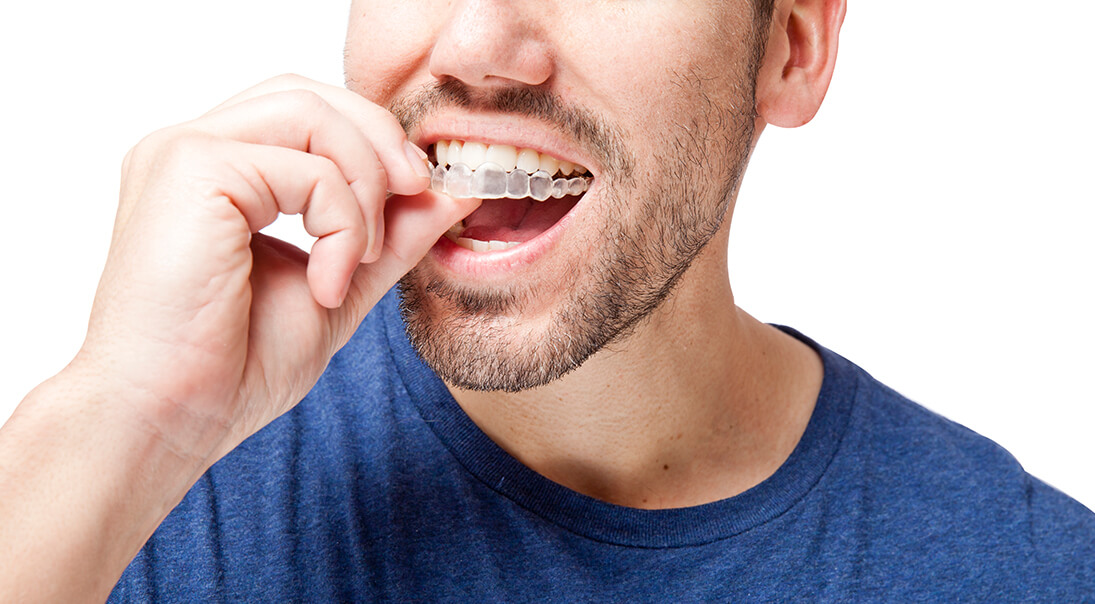 man inserting a clear aligner onto his teeth