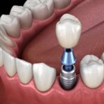 dental implants, tooth replacement, dentist in Lenexa, permanent dentures, dental restoration