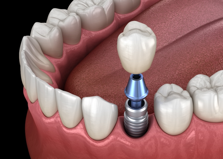 dental implants, tooth replacement, dentist in Lenexa, permanent dentures, dental restoration