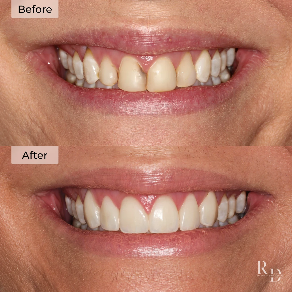 Veneers before and after in Lenexa, KS at Rosehill Dentistry by Dr. Austin Rickabaugh, DDS
