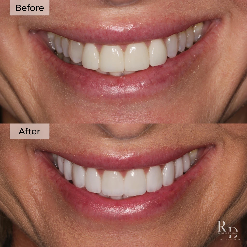Veneers before and after in Lenexa, KS at Rosehill Dentistry by Dr. Austin Rickabaugh, DDS