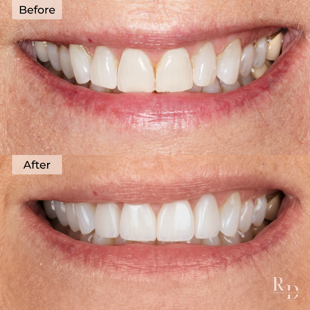 Veneers before and after in Lenexa, KS at Rosehill Dentistry by Dr. Austin Rickabaugh, DDS