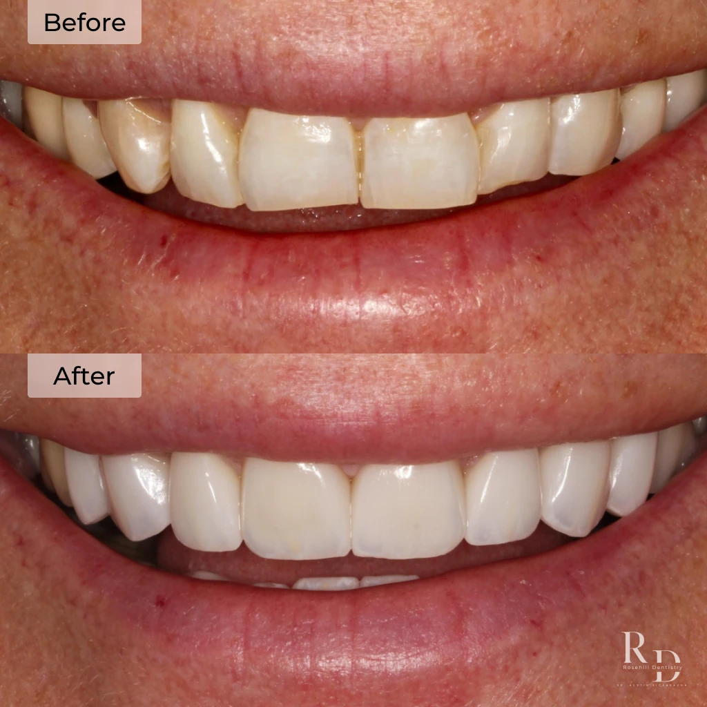 Veneers before and after in Lenexa, KS at Rosehill Dentistry by Dr. Austin Rickabaugh, DDS