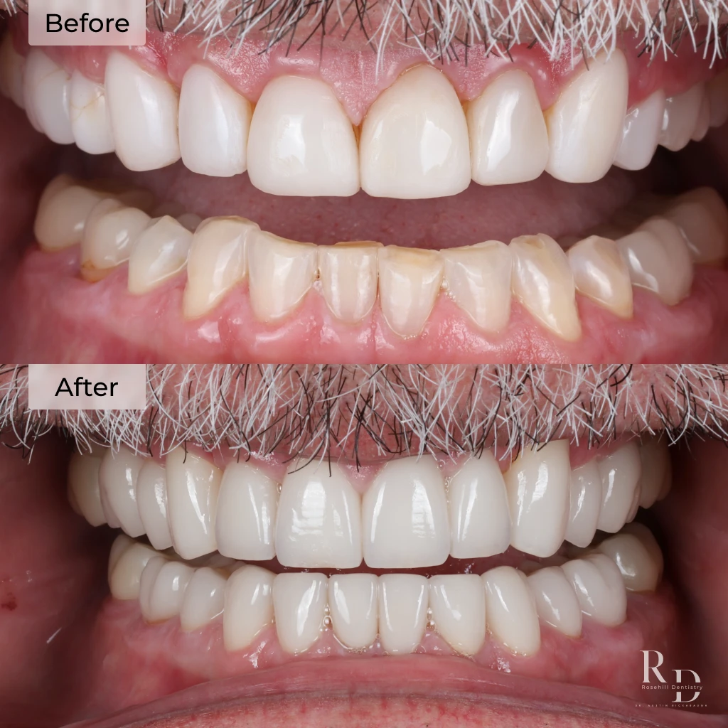 Veneers before and after in Lenexa, KS at Rosehill Dentistry by Dr. Austin Rickabaugh, DDS