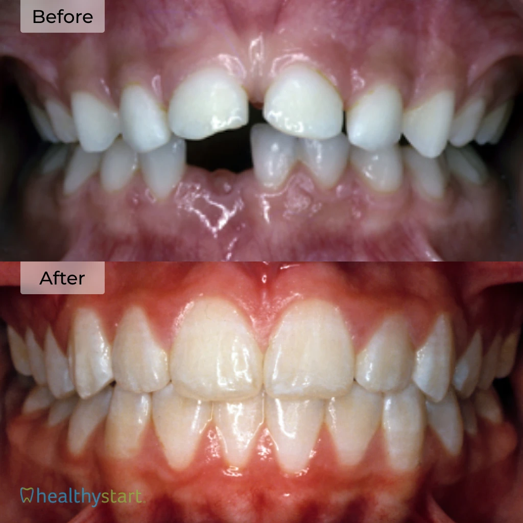 HealthyStart Before And After