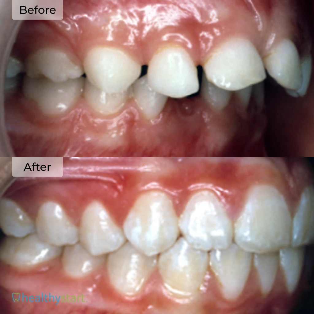 HealthyStart Before And After