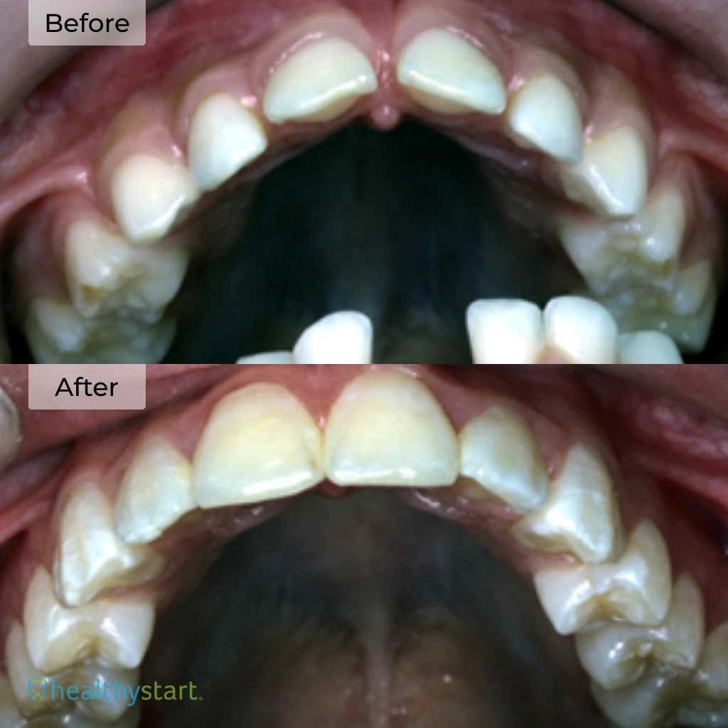 HealthyStart Before And After
