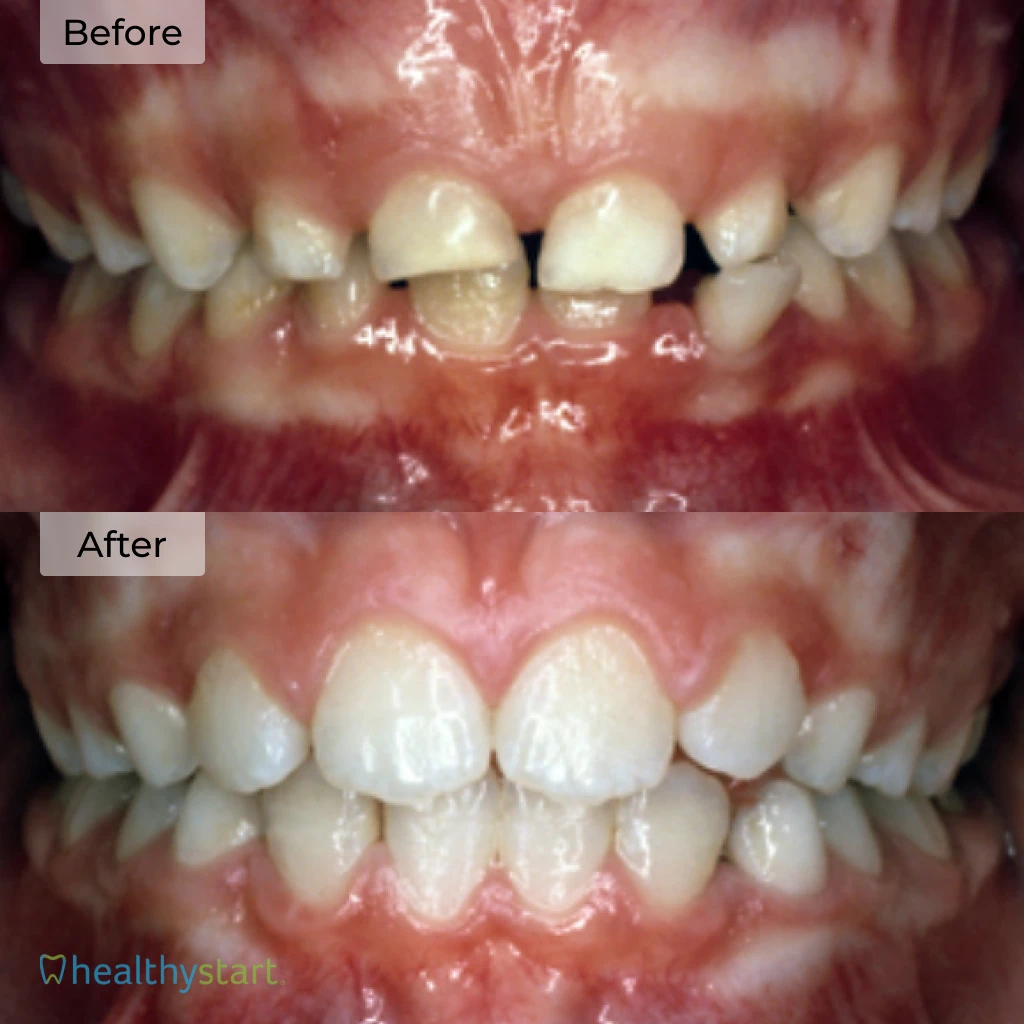 HealthyStart Before And After