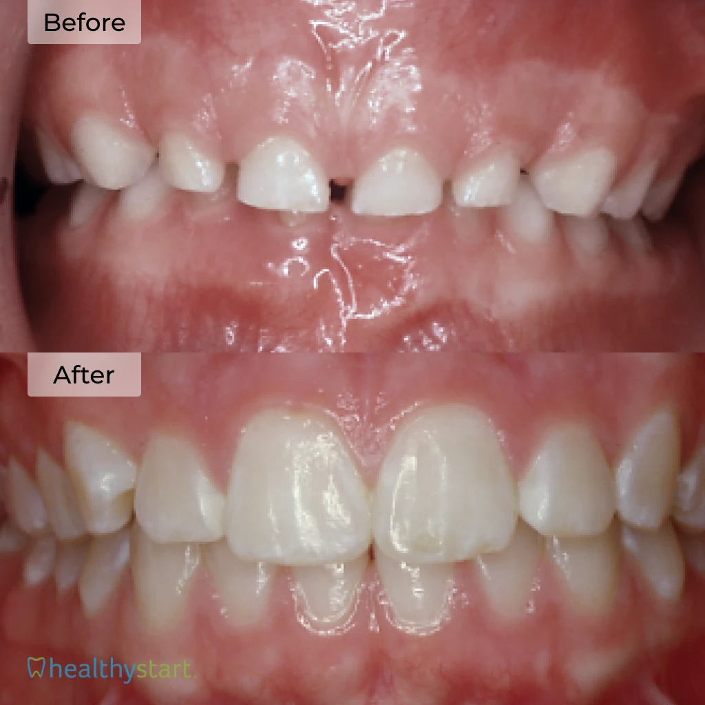 HealthyStart Before And After