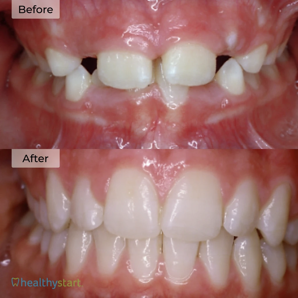 HealthyStart Before And After