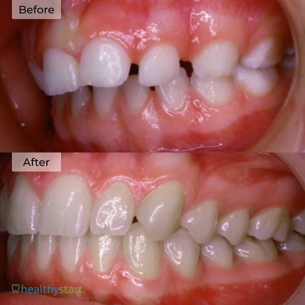 HealthyStart Before And After