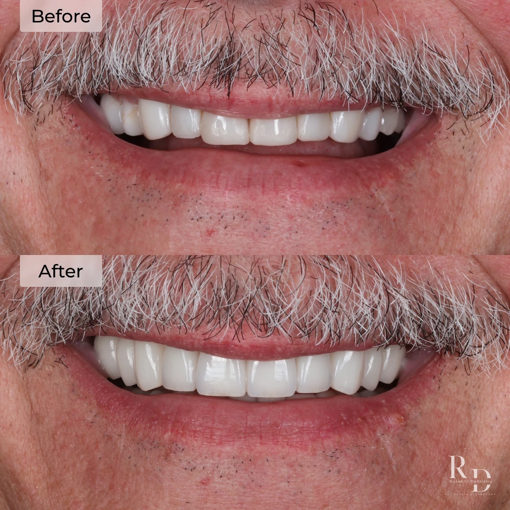 Veneers before and after at Rosehill Dentistry | Privately-owned dentist in Lenexa, KS