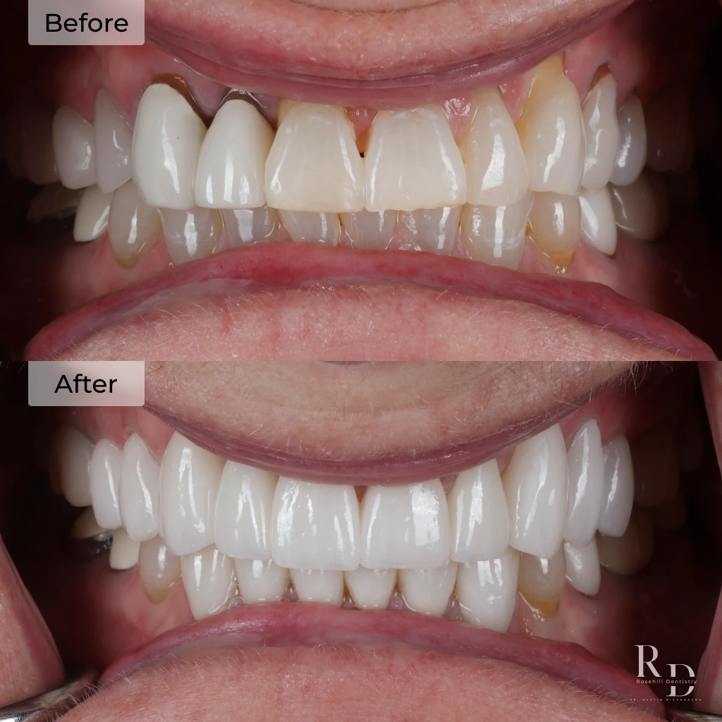 Before and after veneers and dental crowns in Lenexa, KS at Rosehill Dentistry by Dr. Austin Rickabaugh.