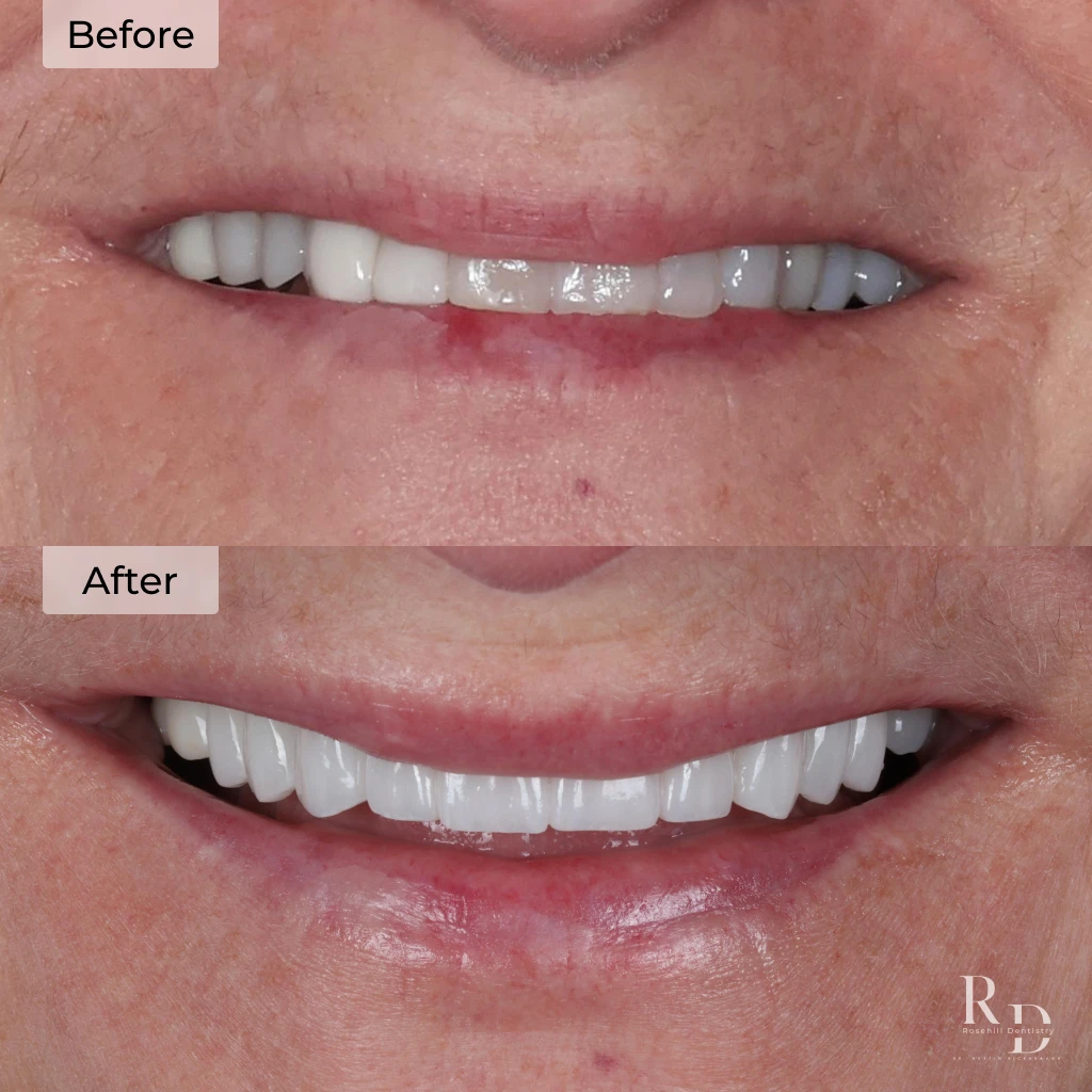 Before and after veneers and dental crowns in Lenexa, KS at Rosehill Dentistry by Dr. Austin Rickabaugh.