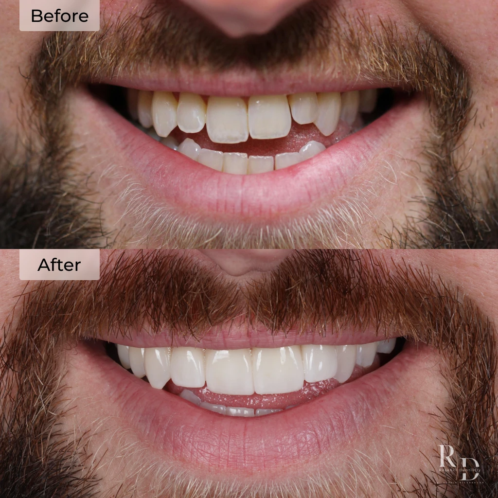 Veneers before and after in Lenexa, KS at Rosehill Dentistry