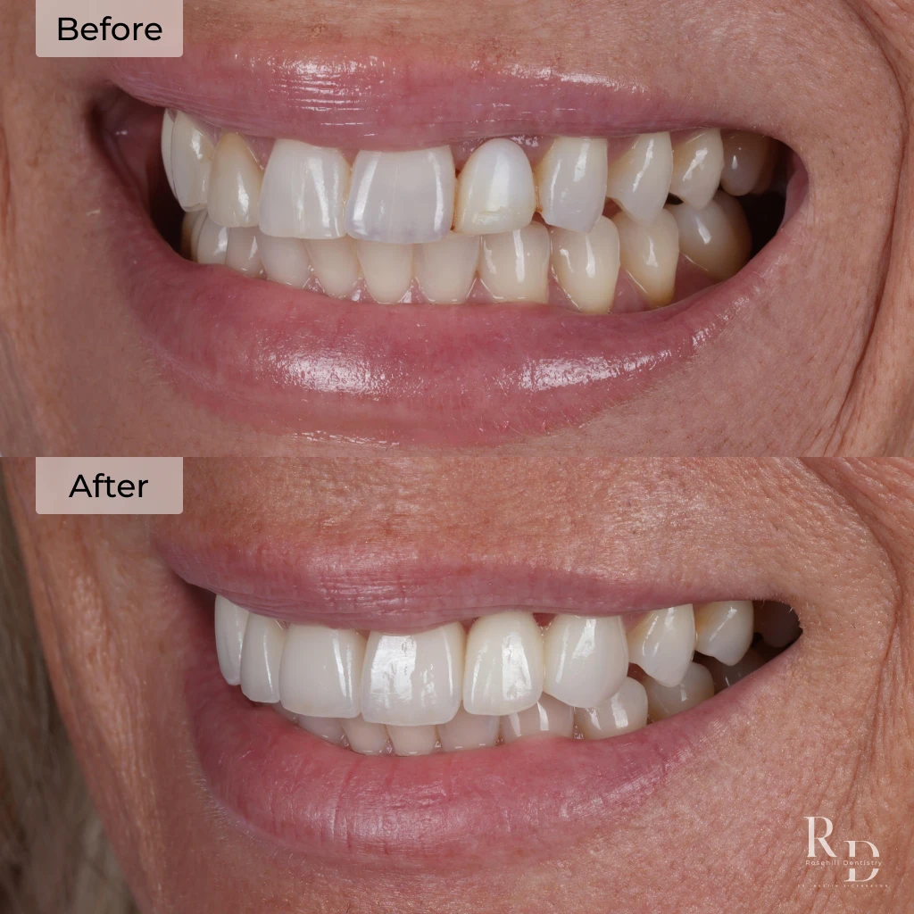 Before and after veneers in Lenexa, KS at Rosehill Dentistry by Dr. Austin Rickabaugh.