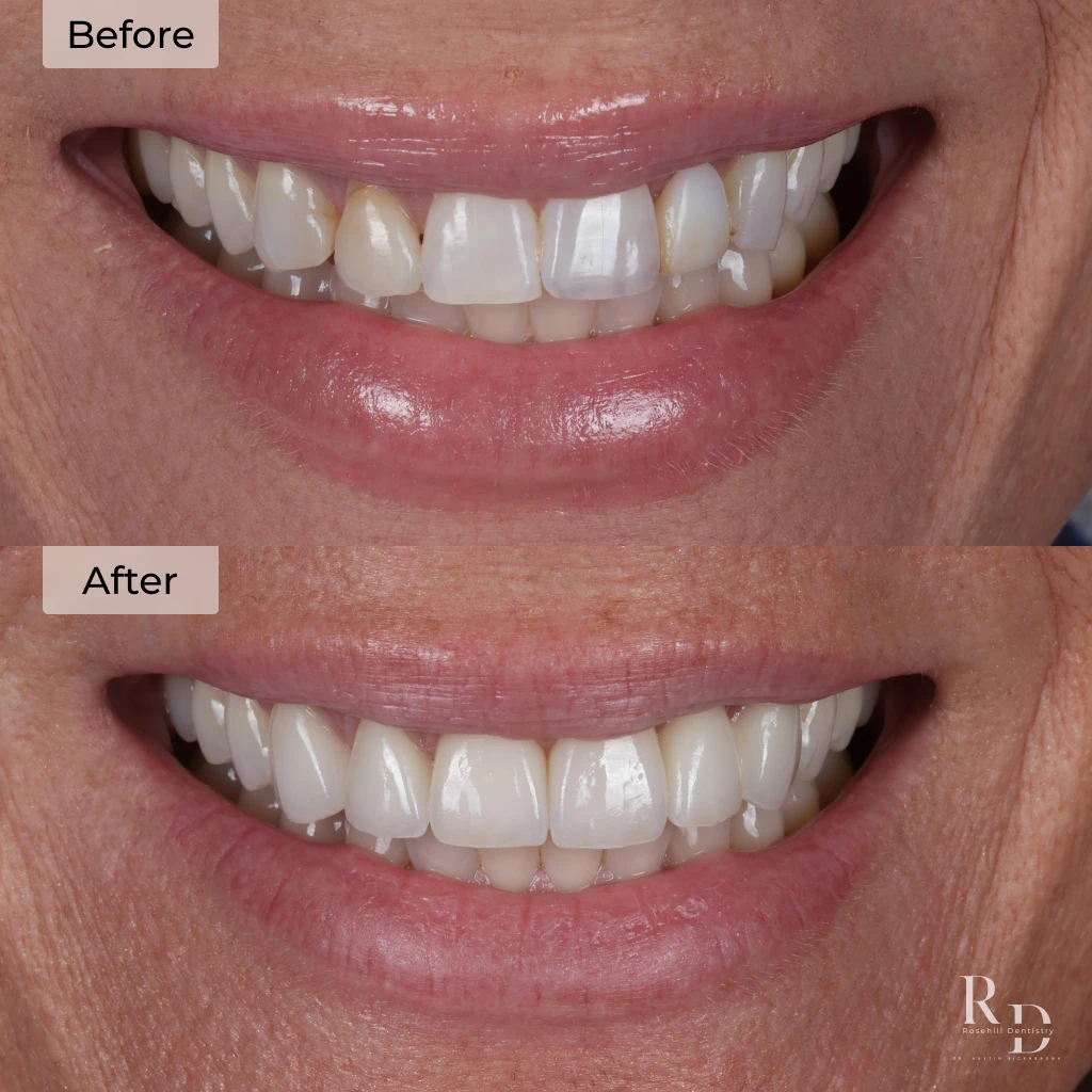 Before and after veneers in Lenexa, KS at Rosehill Dentistry by Dr. Austin Rickabaugh.