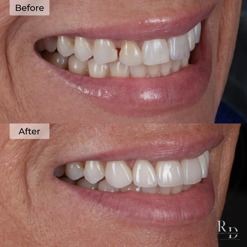 Before and after veneers in Lenexa, KS at Rosehill Dentistry by Dr. Austin Rickabaugh.
